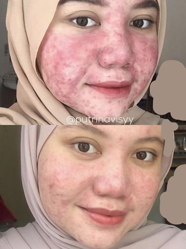 Kisah pejuang acne karena krim abal-abal.