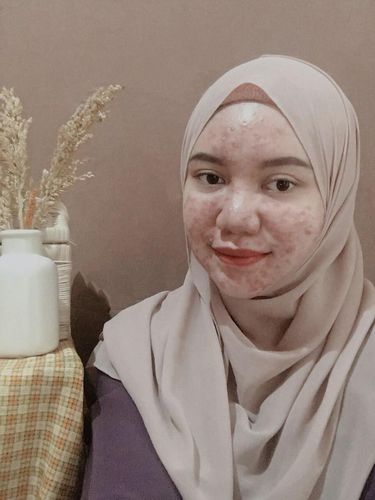 Kisah pejuang acne karena krim abal-abal.