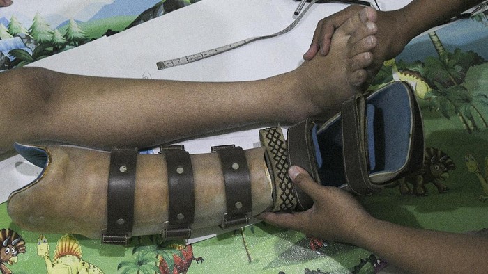 Produksi kaki palsu di Bekasi telah dipasarkan secara nasional. Kaki palsu tersebut dijual dari harga Rp 2 juta hingga puluhan juta rupiah.