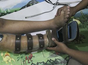 Raup Cuan Puluhan Juta Lewat Pembuatan Kaki Palsu