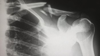 Ketika teknologi sinar-X pertama kali tersedia secara luas untuk dokter anak, mereka melihat sejumlah besar patah tulang yang mengejutkan. Ternyata terungkap banyak anak yang mengalami pelecehan dan kekerasan. Foto: Reddit via Bored Panda