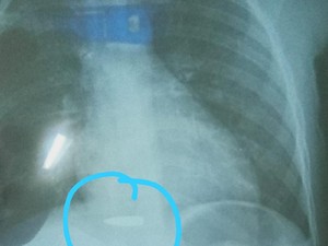 Fakta-fakta Peluru Nyasar Lukai Tubuh Bocah Cihampelas