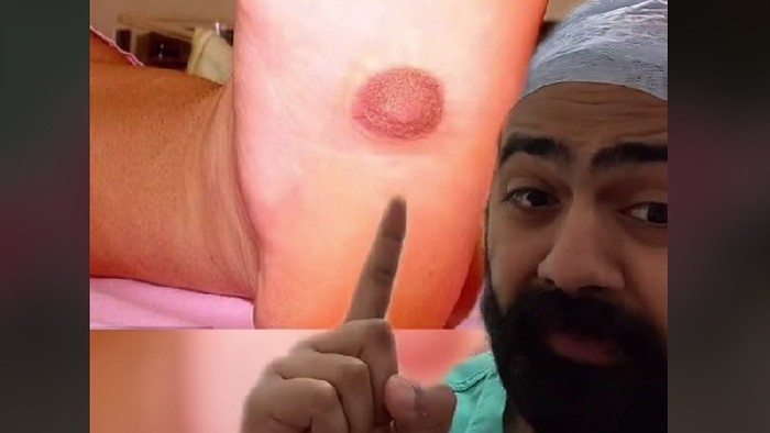 Viral puting di bagian kaki Viral puting muncul di bagian kaki