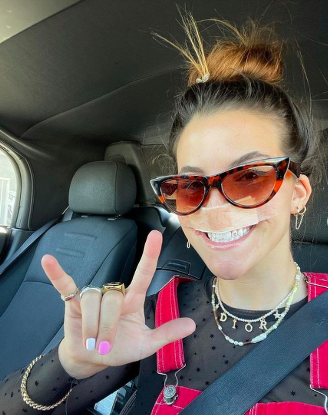 Prosedur tersebut disebut sebagai cangkok kulit. Di mana pengerjaannya cukup kompleks, dan tidak hanya sekali operasi. Operasi plastik tersebut butuh setidaknya lima kali operasi lanjutan. Foto: dok. Instagram/@brookhoury