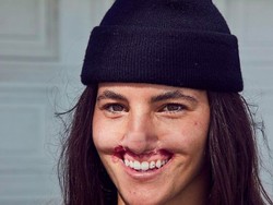 Model Bibirnya Lepas Digigit Anjing, Hasilnya Begini Setelah Oplas Rp 6 Miliar