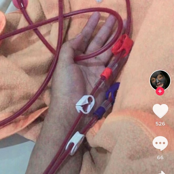 Gegara Tak Suka Minum Air Putih, Wanita Ini Harus Rutin Cuci Darah