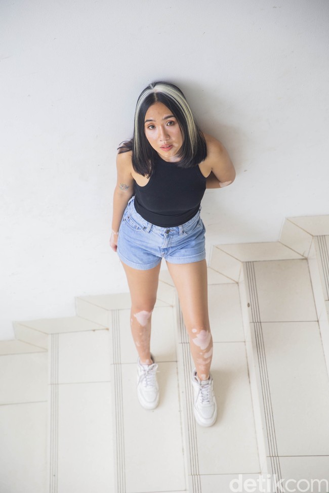 Dari kaki, vitiligonya menyebar ke sekujur badan, bahkan sampai muka sekalipun. Sejak itu, kehidupan Zsazsa berubah. Sibuk menutupi kulit dengan stoking dan plester luka menjadi ritualnya sebelum keluar rumah. (Foto: Grandyos Zafna/detikfoto)