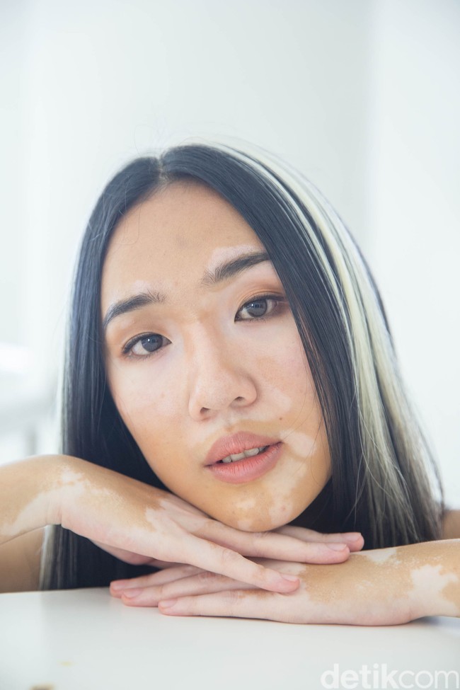 Di dunia modeling, Zsazsa merasa menemukan suaranya. Beberapa kali ia diundang sebagai pembicara di sebuah forum untuk berbagi pengalamannya sebagai pengidap vitiligo. Namun, terkadang perempuan yang bercita-cita menjadi psikolog ini merasa kurang percaya diri berbicara di depan umum. Kalau lewat modeling, tanpa aku ngomong orang sudah bisa melihat, ungkap Zsazsa.(Foto: Grandyos Zafna/detikfoto)