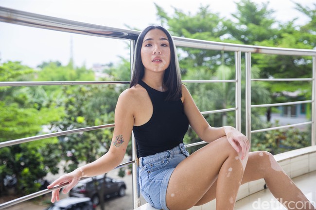 Pernah juga suatu kali ada seorang ibu dan anak menjauh dari Zsazsa saat berpapasan di mal seolah ia sedang membawa penyakit menular. Stigma-stigma seperti vitiligo bisa menular, vitiligo aib atau kutukan masih sering ada. Padahal itu tidak benar sama sekali, katanya.(Foto: Grandyos Zafna/detikfoto)