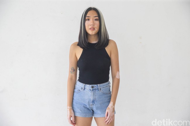 Dulu, sulit bagi Zsazsa Caesar untuk membayangkan dirinya menjadi seorang model. Zsazsa lahir di Bandung, Jawa Barat pada 1 Juni 1995, dengan kondisi fisik yang normal. Sampai ia berusia lima tahun, terjadi keganjilan pada kulitnya. (Foto: Grandyos Zafna/detikfoto)