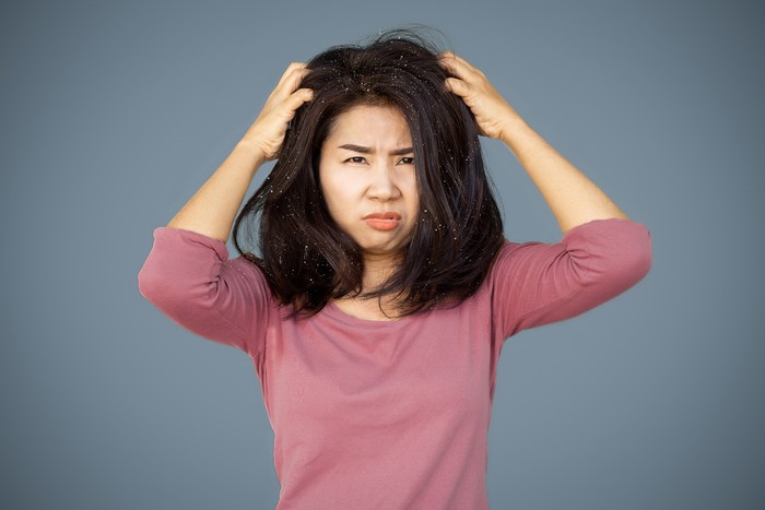 Asian woman hair having problem with dandruff hand itching her dry skin on head