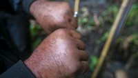 Pemburu madu Nepal Devi Bahadur Nepali, menunjukkan tangannya bengkak setelah disengat lebah saat memanen di Dolakha.