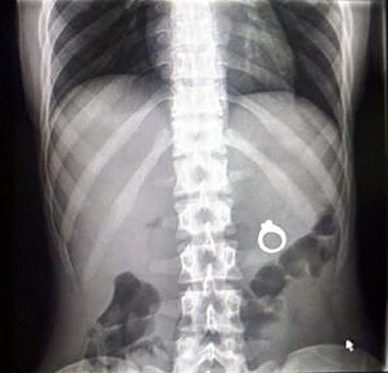 fotoinet hasil sinar x manusia