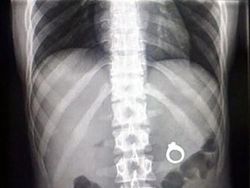 Ngilu! Begini Potret Hasil Sinar X Ray di Dalam Tubuh