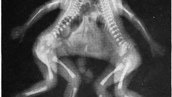 Seperti ini bayi kembar yang dempet. (Foto: Brightside)