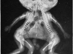 Ngilu! Begini Potret Hasil Sinar X Ray di Dalam Tubuh