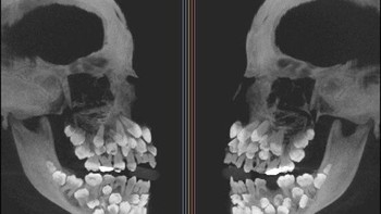 Penampakan seseorang yang mengalami Hyperdontia, merupakan kondisi mulut yang ditandai dengan jumlah gigi yang berlebih, di mana seseorang memiliki lebih dari 20 gigi primer atau lebih dari 32 gigi permanen. (Foto: Brightside)