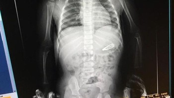 Ada-ada saja,anak gadis ini menelan jepitan rambut. (Foto: Brightside)