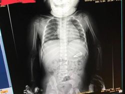 Ngilu! Begini Potret Hasil Sinar X Ray di Dalam Tubuh