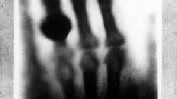 Ini adalah hasil X-ray pertama di dunia, diambil oleh Wilhelm Röntgen pada 22 Desember 1895. (Foto: Brightside)