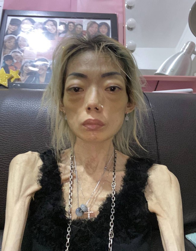 Ia ditemani suaminya dalam beberapa tahun pertama setelah mendapat diagnosis tersebut. Hingga pada 2006, Guo Yongchun mulai menjauh dengan alasan bahwa dirinya lelah dan ingin berpisah untuk beristirahat. Foto: dok. inf news