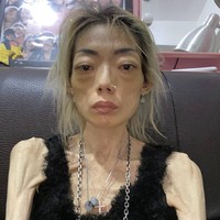 Ia ditemani suaminya dalam beberapa tahun pertama setelah mendapat diagnosis tersebut. Hingga pada 2006, Guo Yongchun mulai menjauh dengan alasan bahwa dirinya lelah dan ingin berpisah untuk beristirahat. Foto: dok. inf news