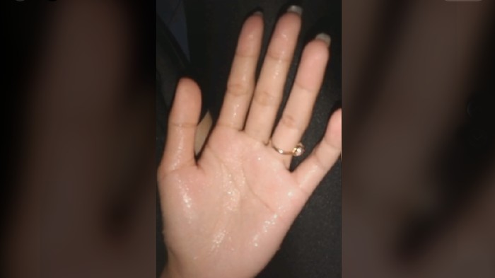 Viral video tentang tangan berkeringat. Tanda penyakit jantung?