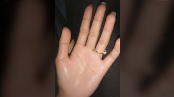 Viral tangan berkeringat Viral video tentang tangan berkeringat. Tanda penyakit jantung?