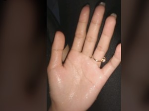 Viral Video Tangan Berkeringat di TikTok, Benarkah Tanda Jantung Lemah?