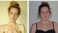 Wanita Ini Hampir Meninggal karena Anoreksia & Bulimia, Beratnya Cuma 28 Kg