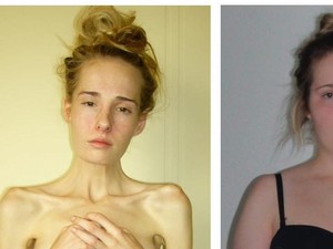 Wanita Ini Hampir Meninggal karena Anoreksia & Bulimia, Beratnya Cuma 28 Kg