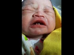 Unik, Bayi di Labura Sumut Lahir Sudah Punya 2 Gigi
