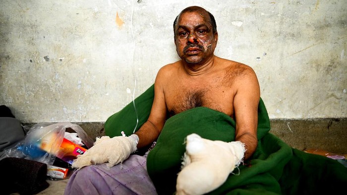 A survivor of a ferry fire receives treatment at a government medical hospital, in Barishal, Bangladesh, Friday, Dec. 24, 2021. Bangladesh fire services say at least 37 passengers have been killed and many others injured in a massive fire that swept through a ferry on the southern Sugandha River. The blaze broke out around 3 a.m. Friday on the ferry packed with 800 passengers. (AP Photo/Niamul Rifat)
