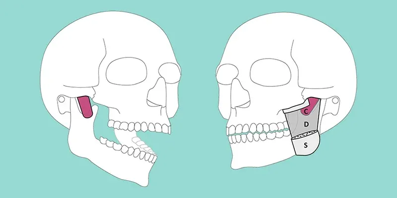 Otot masseter memiliki lapisan superfisial (S), dalam (D), dan lebih dalam (C = koronoid). Foto: Jens C. Türp, UZB