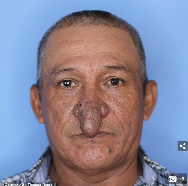 Pria yang bekerja sebagai tukang cat dan pekerja konstruksi itu mengatakan saat dia tidak memakai masker, orang-orang akan memerhatikannya. Dan anak-anak yang melihatnya akan bertanya pada orangtuanya tentang apa yang terjadi pada hidung Conrado. Foto: Dok. Dr. Thomas Romo