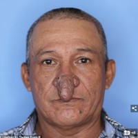 Pria yang bekerja sebagai tukang cat dan pekerja konstruksi itu mengatakan saat dia tidak memakai masker, orang-orang akan memerhatikannya. Dan anak-anak yang melihatnya akan bertanya pada orangtuanya tentang apa yang terjadi pada hidung Conrado. Foto: Dok. Dr. Thomas Romo