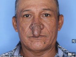 Transformasi Pria yang Viral Hidungnya Mirip Alat Kelamin Kini Bisa Tersenyum