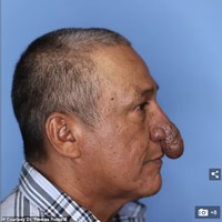 Seperti dikutip dari New York Post, selama bertahun-tahun, Conrado kesulitan makan dan bernafas karena kondisi hidungnya tersebut. Hidung pria 57 tahun itu membesar hingga bentuknya disebut mirip alat kelamin pria. Dia pun jadi selalu mendengkur saat tidur dan suaranya saat berbicara tidak normal. Foto: Dok. Dr. Thomas Romo