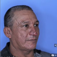 Secara medis apa yang dialami Conrado disebut rhinophyma. Rhinophyma merupakan variasi dari derajat, tipe, dan perluasan bentuk hidung yang irregular, buruk, dan distorsi hipertrofik. Hingga kini penyebab Rhinophyma belum diketahui. Namun demikian Rhinophyma merupakan kelainan yang relatif langka terjadi. Foto: Dok. Dr. Thomas Romo