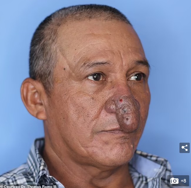 Pria bernama Conrado Estrada menjadi viral karena dokter bedah plastik menyebut hidungnya mirip alat kelamin pria. Conrado selama hidupnya harus hidup dengan bentuk hidung yang tidak biasa. Dia terpaksa selalu memakai masker ke manapun saat keluar rumah untuk menyembunyikan hidungnya. Foto: Dok. Dr. Thomas Romo