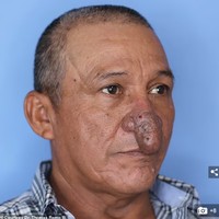 Pria bernama Conrado Estrada menjadi viral karena dokter bedah plastik menyebut hidungnya mirip alat kelamin pria. Conrado selama hidupnya harus hidup dengan bentuk hidung yang tidak biasa. Dia terpaksa selalu memakai masker ke manapun saat keluar rumah untuk menyembunyikan hidungnya. Foto: Dok. Dr. Thomas Romo