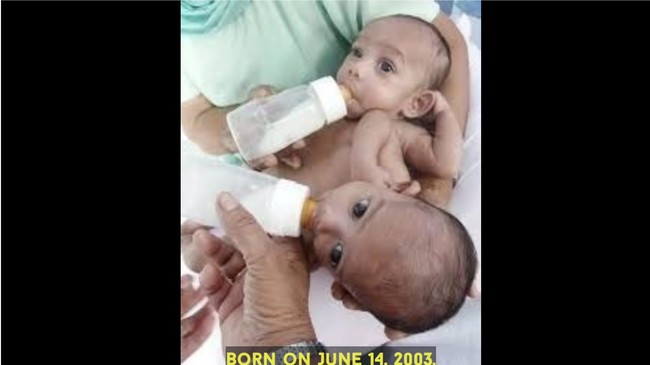 Sohna dan Mohna Singh adalah kembar siam asal India berusia 19 tahun. Mereka harus hidup berdampingan karena hanya memiliki satu pasang kaki, kantung empedu, limpa, dan hati. Ketika lahir, dokter mengatakan terlalu berisiko untuk memisahkan keduaya. Karena kondisinya, mereka ditinggal oleh orang tua ketika berusia dua bulan.Foto: Dok. YouTube Tangy Tales