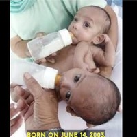 Sohna dan Mohna Singh adalah kembar siam asal India berusia 19 tahun. Mereka harus hidup berdampingan karena hanya memiliki satu pasang kaki, kantung empedu, limpa, dan hati. Ketika lahir, dokter mengatakan terlalu berisiko untuk memisahkan keduaya. Karena kondisinya, mereka ditinggal oleh orang tua ketika berusia dua bulan.Foto: Dok. YouTube Tangy Tales