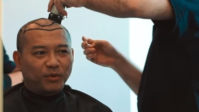 anang hermansyah, ashanty anang hermansyah lakukan transplantasi rambut