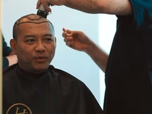 Transplantasi Rambut Seperti Anang-Atta, Seberapa Efektif Atasi Kebotakan?