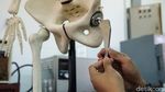 BRIN Kembangkan Implan Pengganti Sendi Buatan dalam Negeri