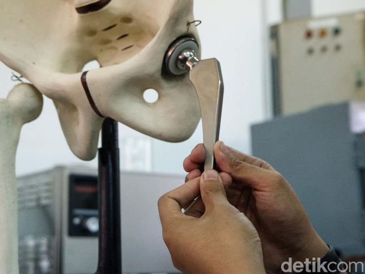 BRIN Kembangkan Implan Pengganti Sendi Buatan dalam Negeri