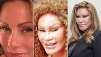 Jocelyn Wildenstein. Wanita kaya ini cukup tersohor karena tingkahnya. Dia rela menghabiskan jutaan dolar untuk operasi plastik yang malah bikin dia terlihat aneh. Lihat nih perubahan wajahnya. Foto: The Mirror via Scoopwhoop