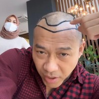 Melalui akun Instagramnya, Anang Hermansyah sempat terlihat menjelaskan proses transplantasi rambut yang akan dijalaninya itu. Keputusan tersebut memang dipilih oleh Anang karena dia merasa rambutnya sudah semakin botak dan menipis. Foto: Instagram/@ananghijau