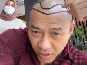 Ini Kisaran Biaya Transplantasi Rambut di Turki Seperti Anang Hermansyah